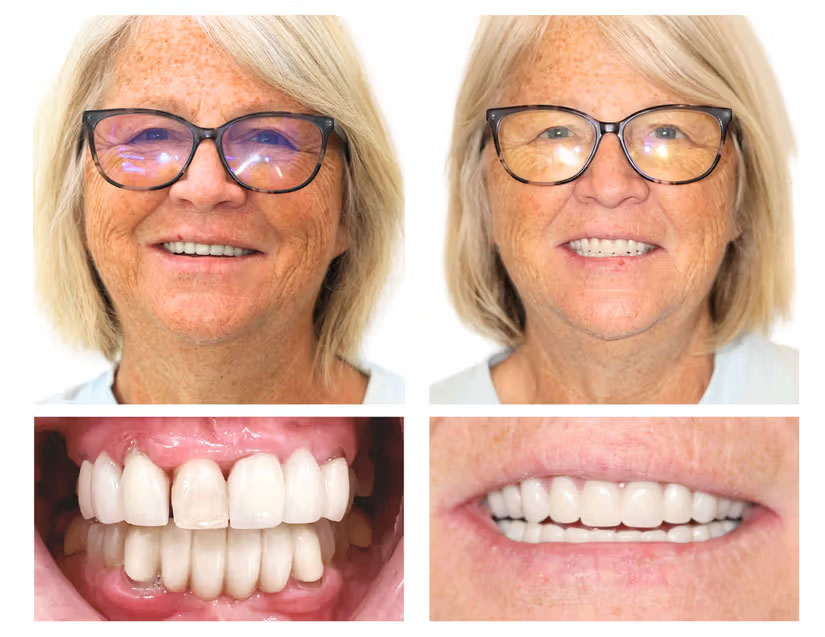 dental implant case 2 before after