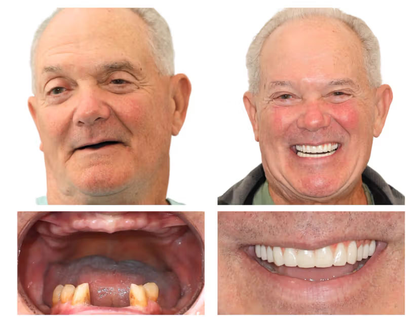 dental implant case 3 before after