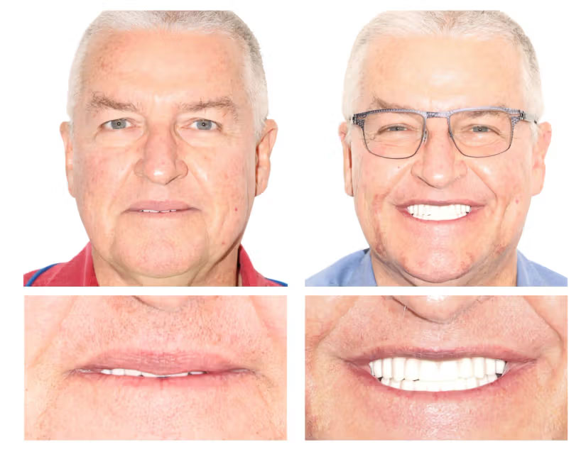 dental implant case 4 before after