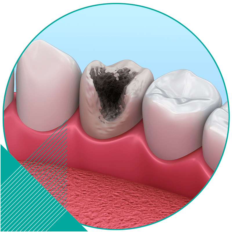 tooth decay