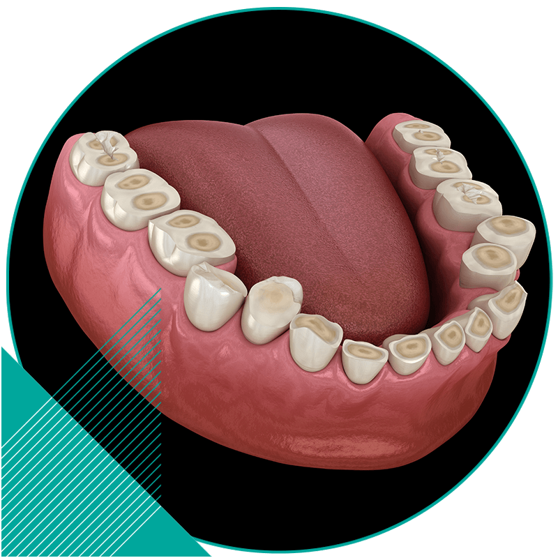 Grinding teeth