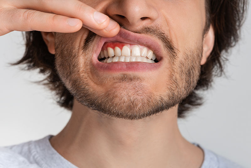 Gum disease