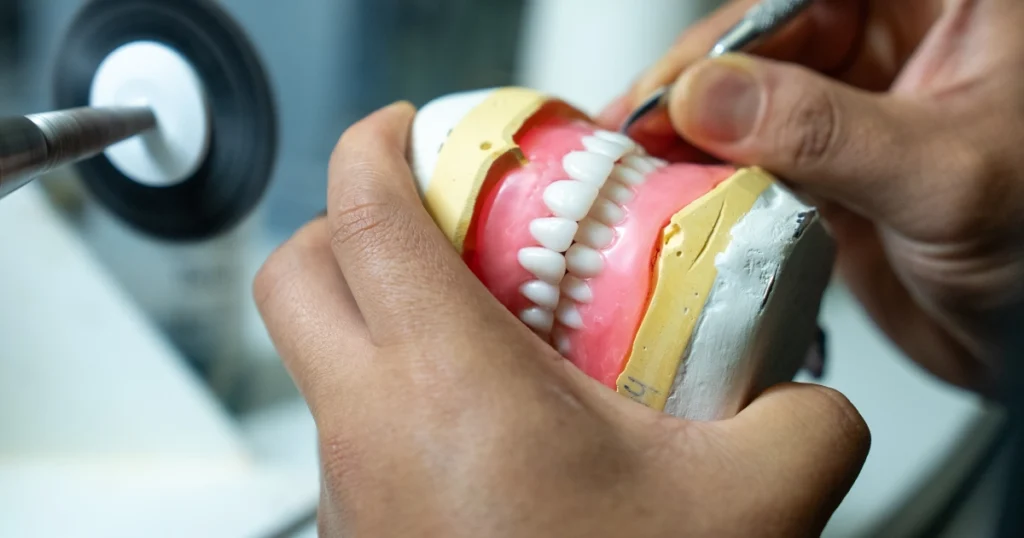 All-on-4 bridge anchored to four dental implants in the lower jaw