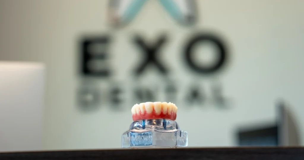 All-on-4 fixed implants compared with a removable traditional denture