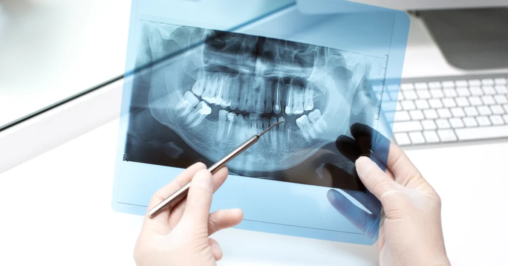 Illustration showing a dental bone graft rebuilding jawbone to support a dental implant