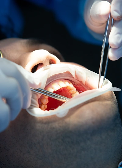 Dentist explaining full-arch implant options to a patient