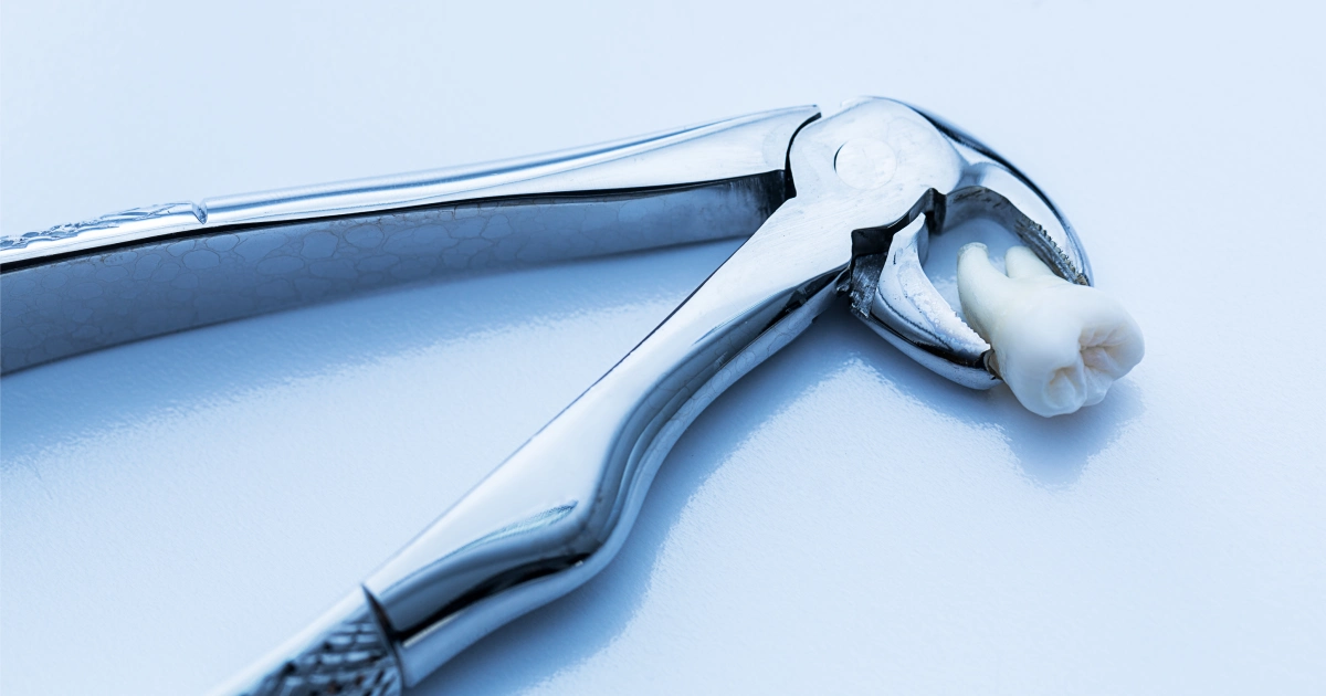 Comparison illustration of a simple tooth extraction versus a surgical extraction