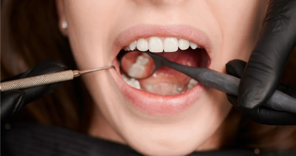 Dentist treating a dry socket after tooth extraction