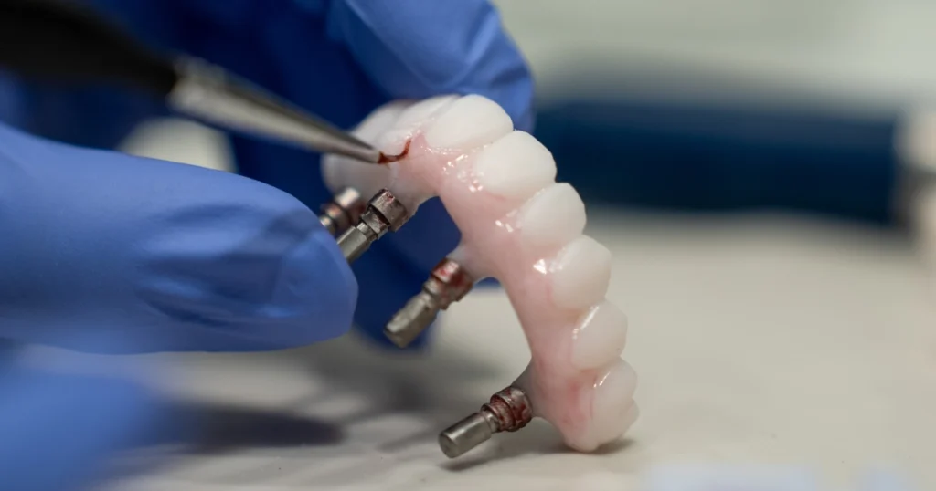 Dentist placing same-day implants using a 3-D surgical guide