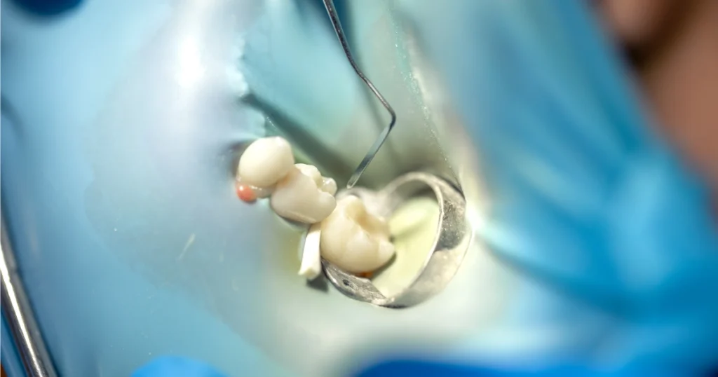 Impacted wisdom tooth procedure showing why removal can be more complex