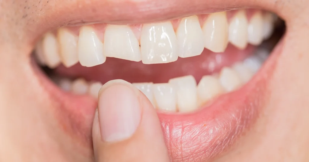 Close-up of a person pointing to a small chipped front tooth