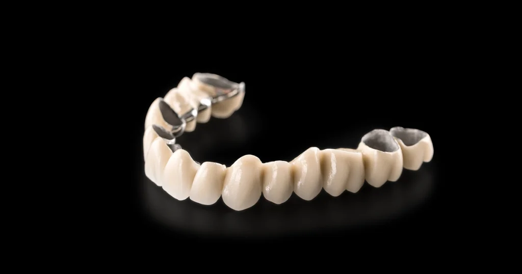 3d model showing the difference between dental bridge vs dental implant