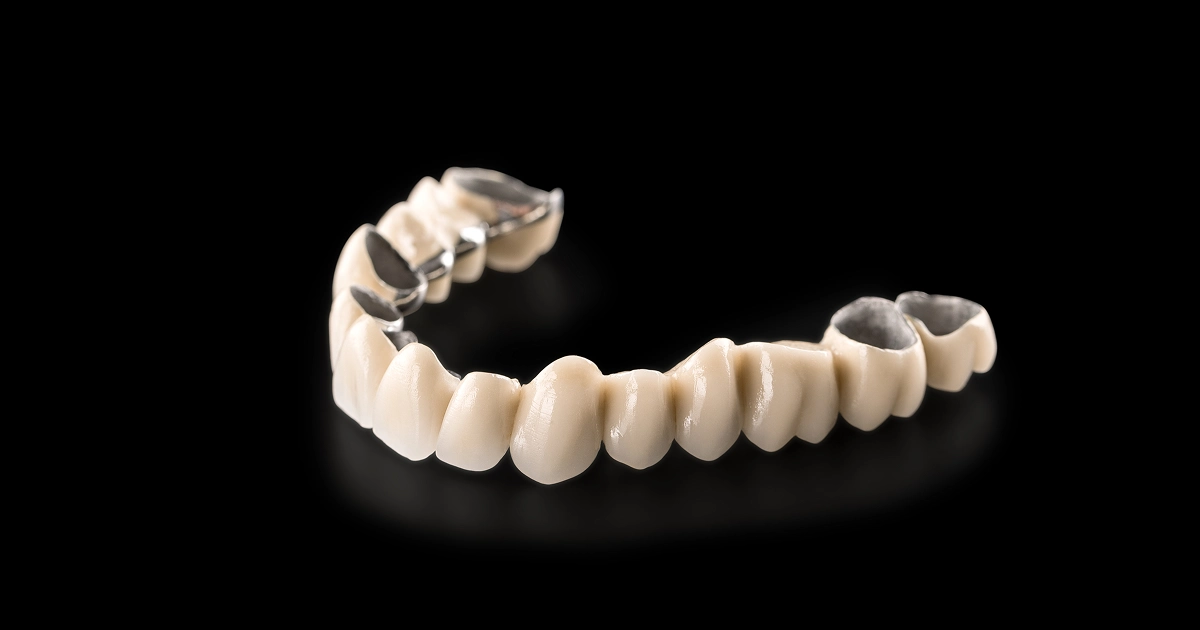 3d model showing the difference between dental bridge vs dental implant