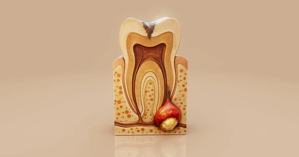 Illustration showing a periapical tooth abscess at the root tip of a tooth