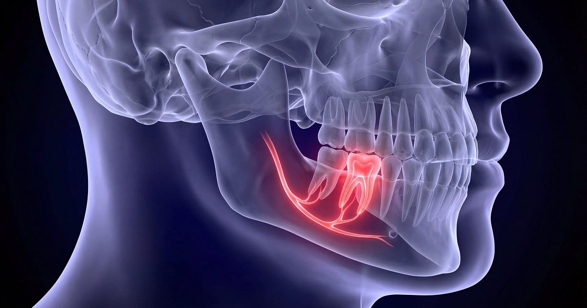 Dental X-ray showing an impacted wisdom tooth angled against the neighboring molar